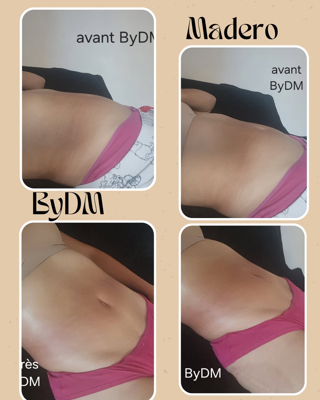 maderotherapie cible ventre