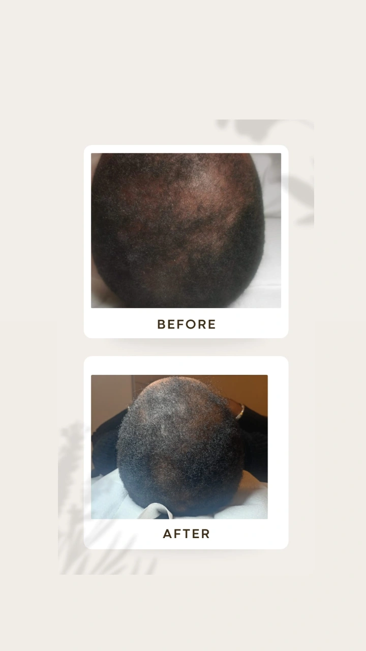 Soins hairneedling sur homme