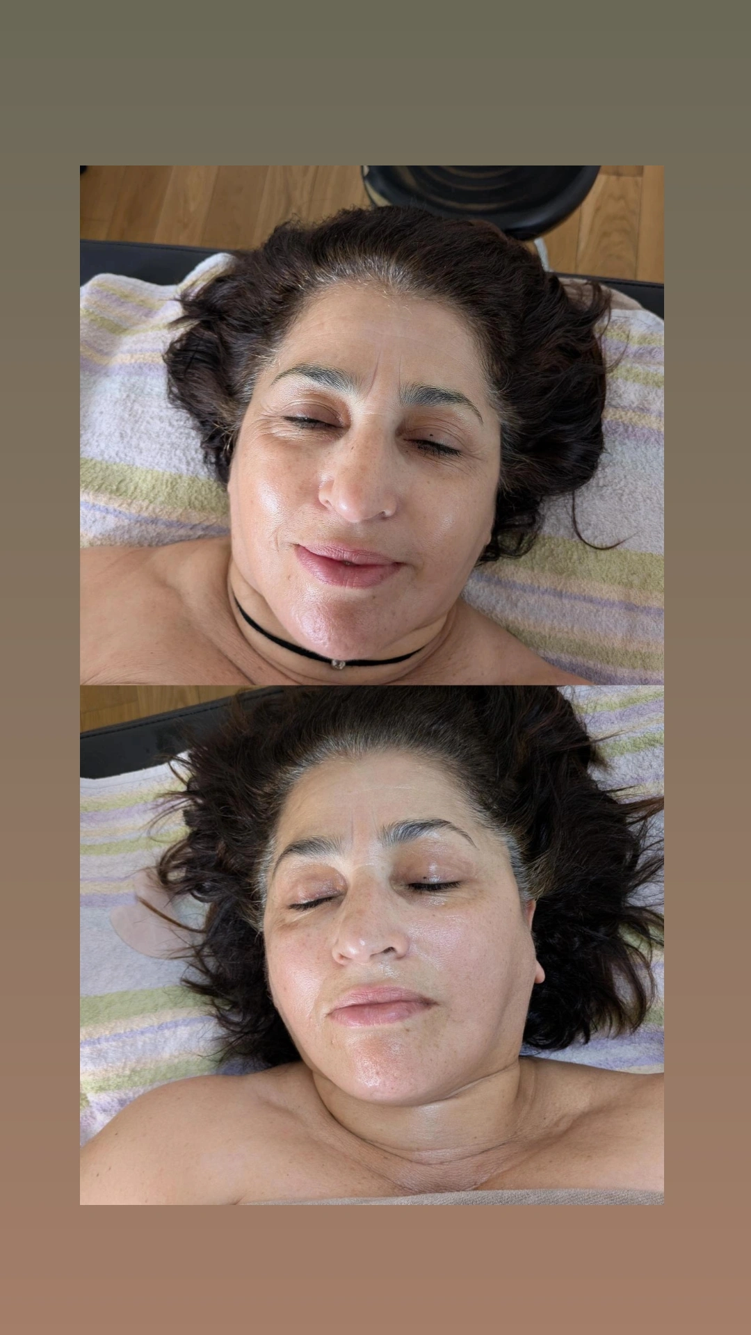 Résultat après un massage Kobido 🌸