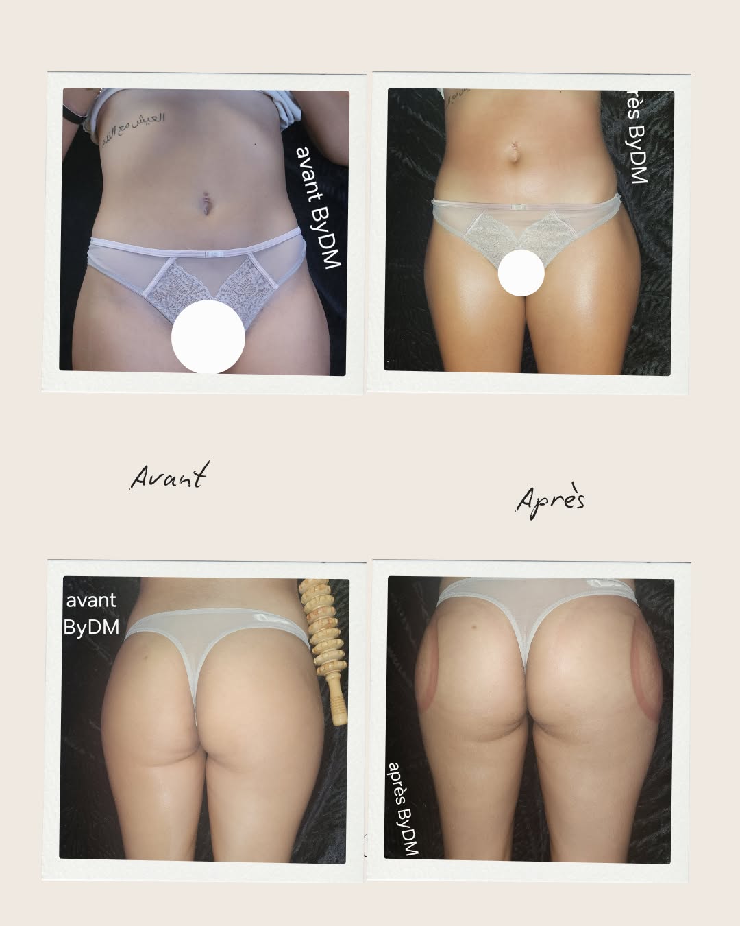 maderotherapie et lifting colombien combiné
